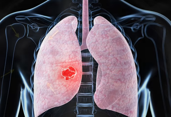 graphic representation of two lungs inside the chest cavity and a tumor is illuminated in one of the lungs