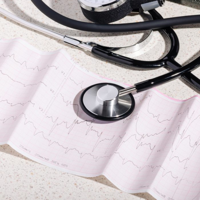 Tonometer and cardiogram showing diagnosis of atrial fibrillation, abnormal heart rhythm, arrhythmia