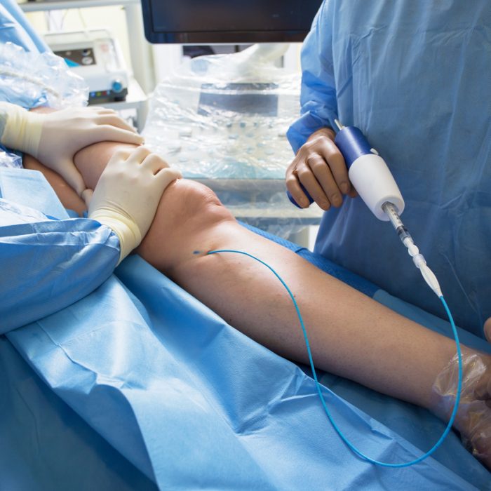 Doctors doing vein surgery procedure