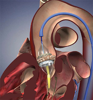Minimally Invasive Aortic Valve Replacement