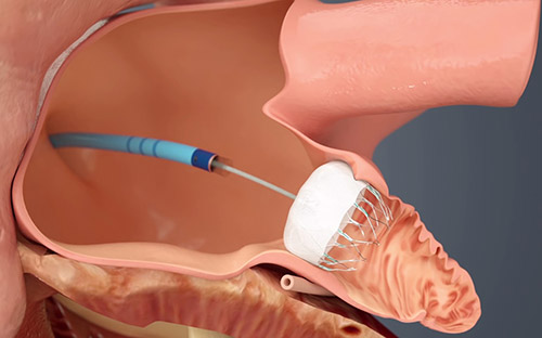 Watchman Implant