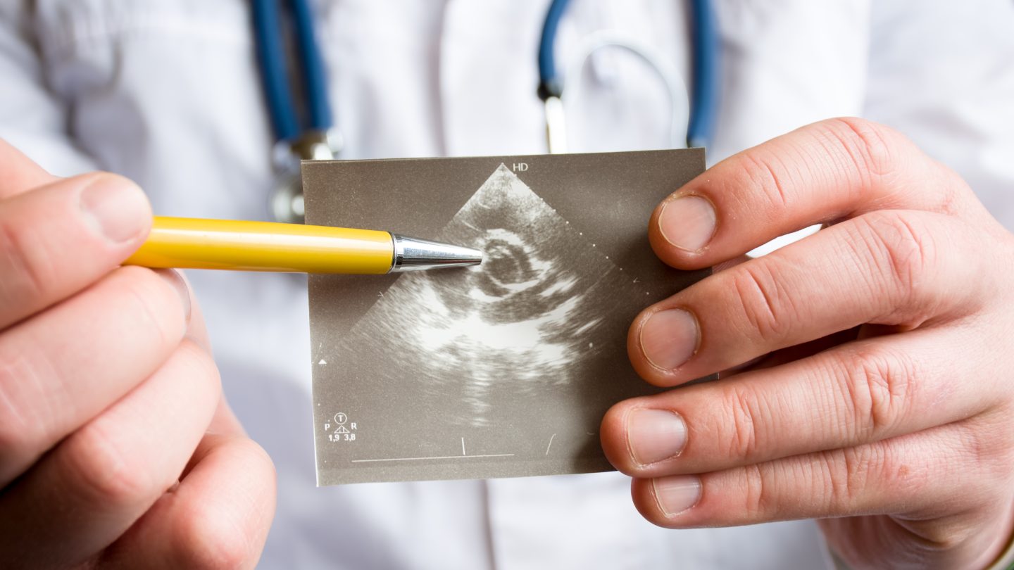 Ultrasound of Heart