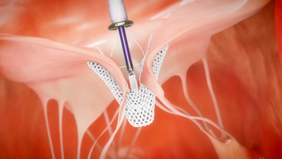 TriClip™ for Tricuspid Regurgitation